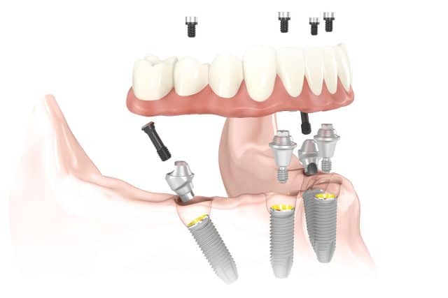 Single Tooth Dental Implants illustration