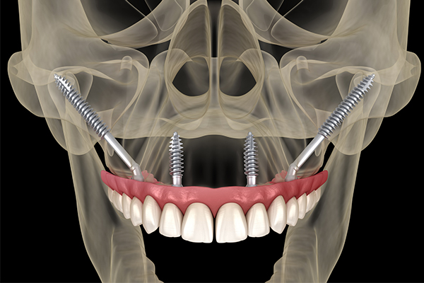 Mini Dental Implants (MDIs) illustration
